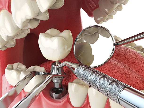 Best Emergency Dentist for Knocked-Out Tooth in Jonesville, LA